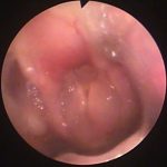 タカハシナナ150301BS 喉頭-著しい喉頭狭窄