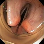 ワタナベリン1508013BS-喉頭の異常運動3ー呼気時動的喉頭狭窄