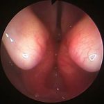 VB#444-喉頭虚脱-タカハシルンタ150123喉頭