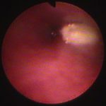 症例160211-イケダロン160211PRS01-後鼻孔部に異物