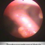 Veterinary Bronchoscopy#502, Tracheoesophageal fistula, Chihuahua 10Y M, ID6428サイトウダイズ151012