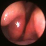 Veterinary Bronchoscopy#572, Chronic laryngitis and mucostasis associated with chronic rhinitis, Miniature Dachshund 11Y F, ID6634ホリウチメイ160822BS+RS