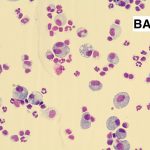 ウチダカイ161015-BALF細胞診X40-Chronic-active inflammation-2 のコピー